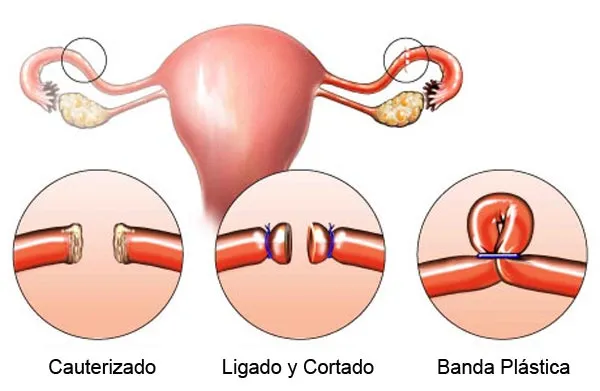 Ligadura de trompas ventajas